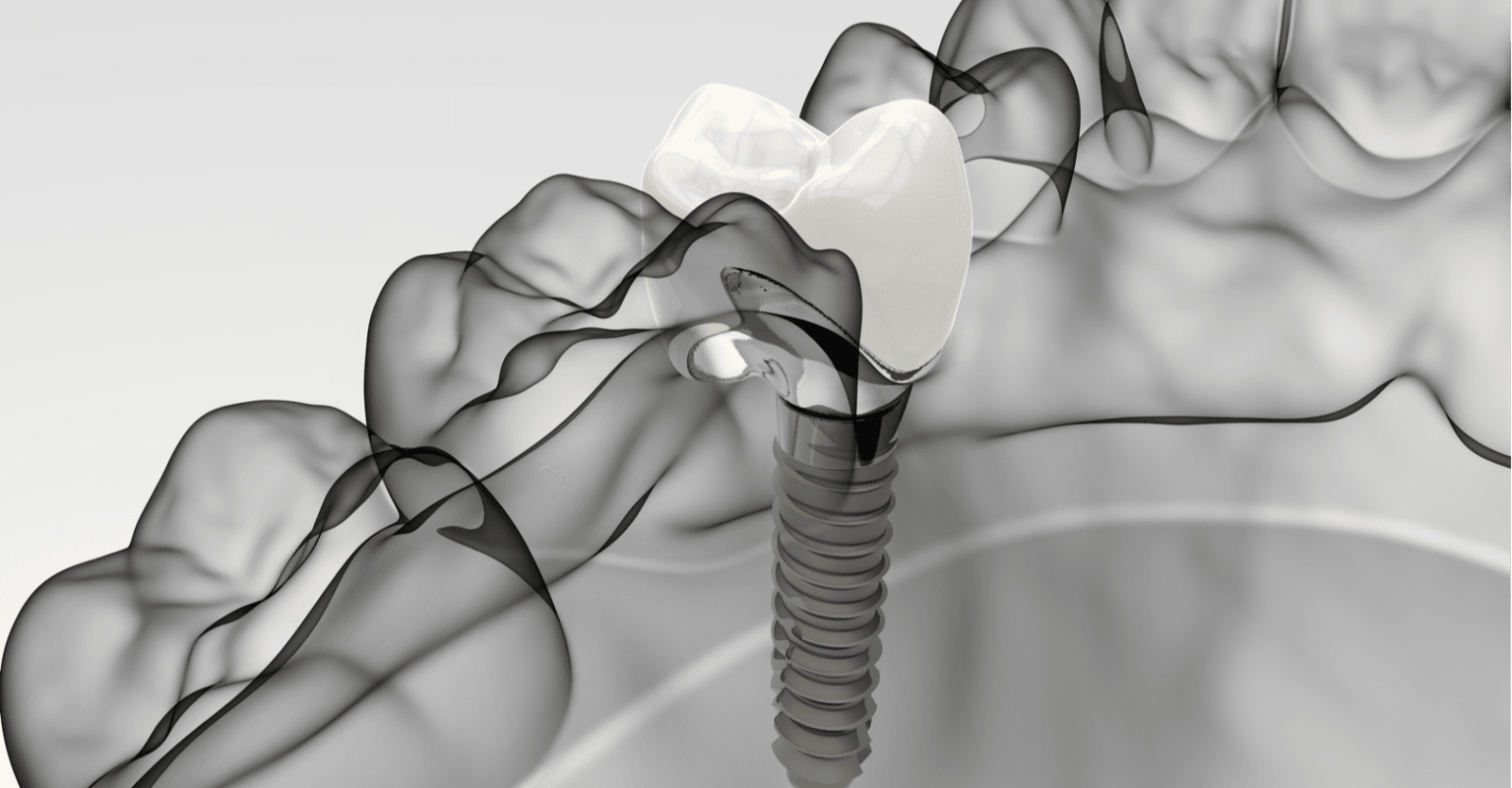 Single Dental Implants Sandbach Patients Gain Increased Access to More Consultation Slots at Crown Bank Dental